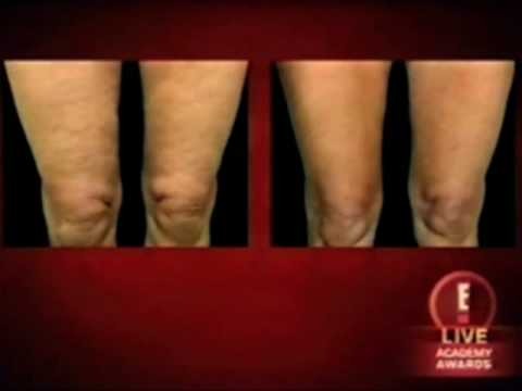 Thermage - Oprah TV clips